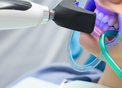 オフィスホワイトニング（片顎）