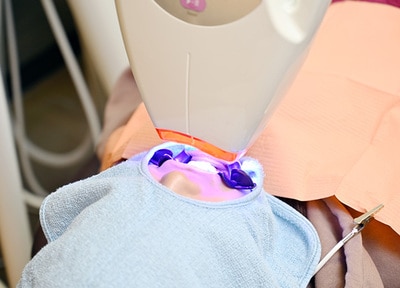 オフィスホワイトニング