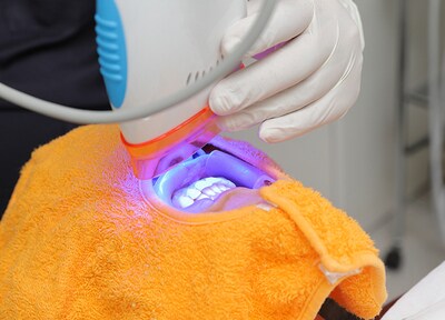 オフィスホワイトニング(全顎)