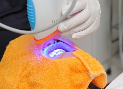 オフィスホワイトニング(全顎)6回コース