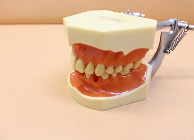 歯石をとる予防で虫歯や歯周病を抑えた健康な歯につなげる治療
