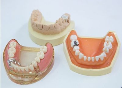 治療後も調整を重ね、患者さまにとって快適な入れ歯を目指します。
