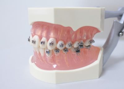 矯正治療で歯並びを整え、お口を健康に保ちやすくする