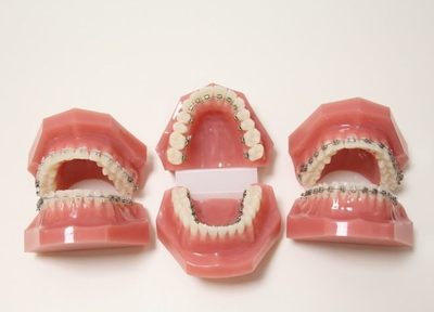 Q.成人矯正にはどのような種類がありますか？