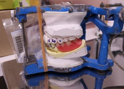 中島歯科医院 入れ歯・義歯