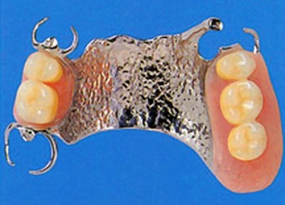 金属床の入れ歯