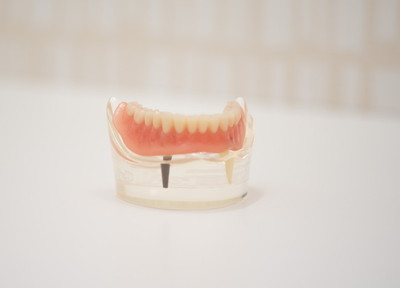インプラントによる負担をとどめ、歯の機能を取り戻すことができるインプラントオーバーデンチャーをご提案しております