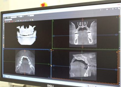 歯科用CTで細部までしっかり診査しています