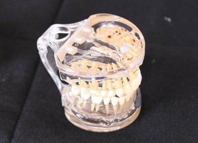 ちあーず歯科・小児歯科 つめ物・かぶせ物