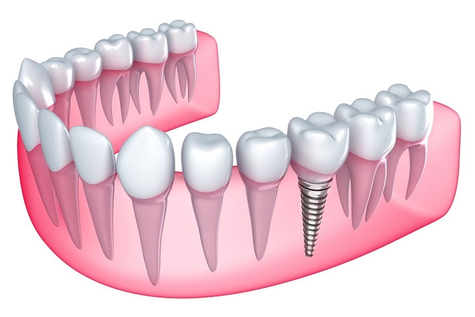 インプラントのためのオペ室で、細心の注意を払って手術を行います