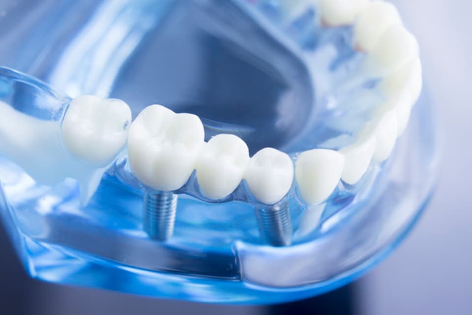 患者さまの負担を軽減すべく、歯科用CTやサージカルガイドを使用します