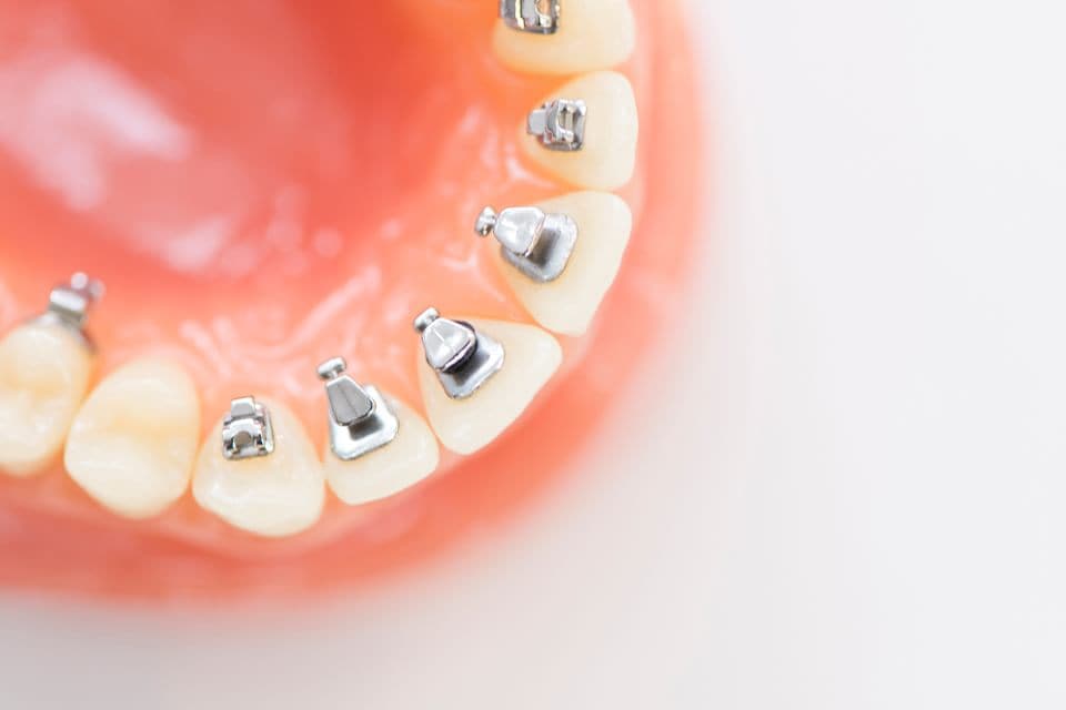 裏側矯正とマウスピース矯正を組み合わせた、目立ちにくい矯正治療をご提案