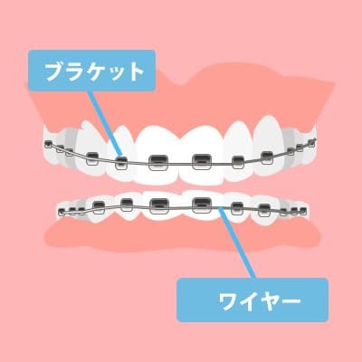 歯並びの矯正はなぜあんなに費用がかかるのか？