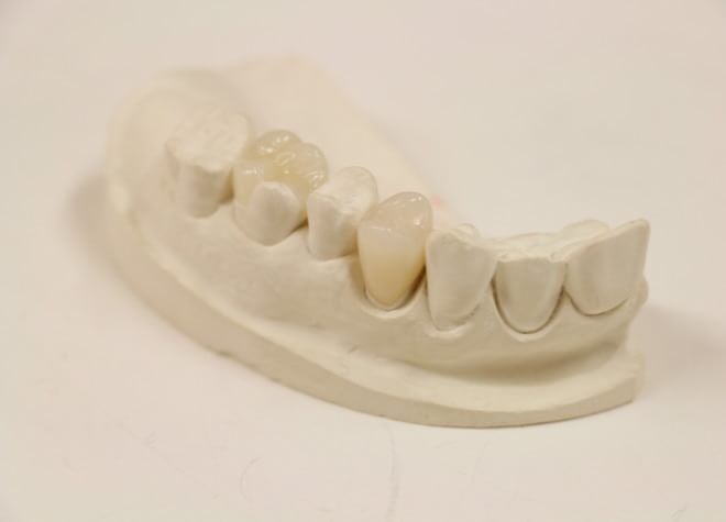 Q.銀歯を避けたい場合に何か良い方法はありますか？