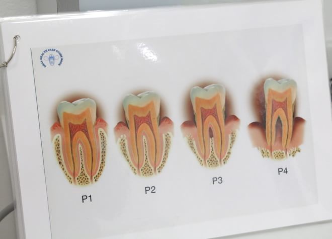 Q.歯周病の治療内容を教えてください。