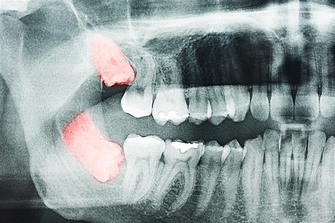 切開を伴う抜歯もお任せください。痛みを極力抑えながら処置を進めます。