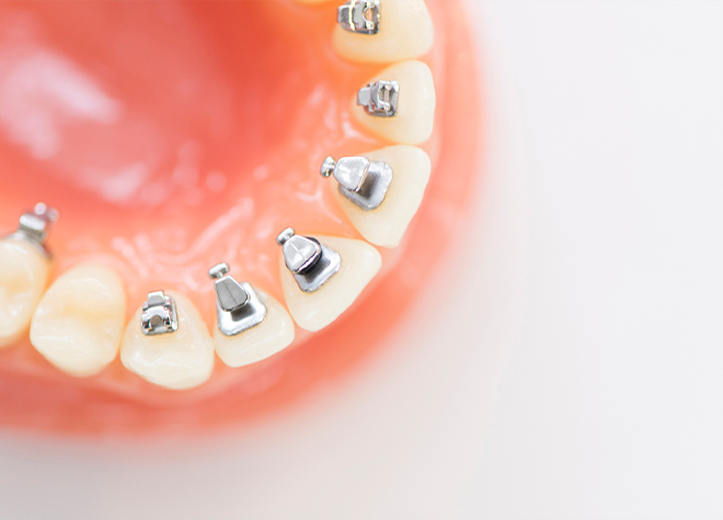 歯の裏側に装置を取り付ける矯正治療にも対応しています