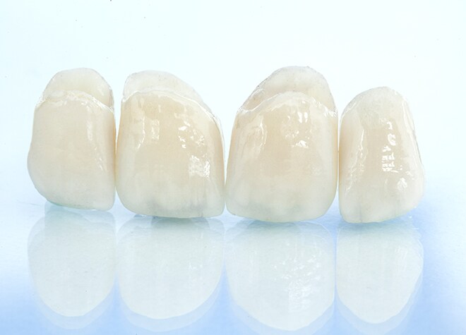お口元が気になる方に白いつめ物・かぶせ物をおすすめしています
