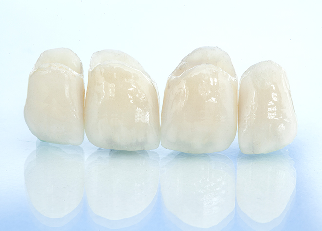 虫歯の原因改善のための治療と患者さまの価値観に合わせた素材の選択