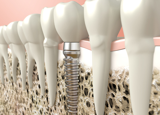 インプラントは、歯科治療における最終的な治療法だと考えます