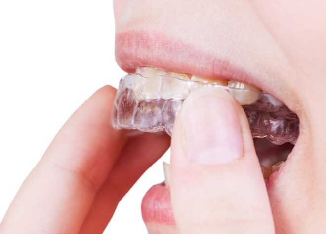 矯正中の見た目が不安な方は、透明なマウスピース矯正をご検討ください