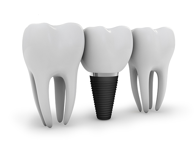 健康な歯を余分に削る必要のない、お口の中のバランスを大切にしたインプラント治療を行っています