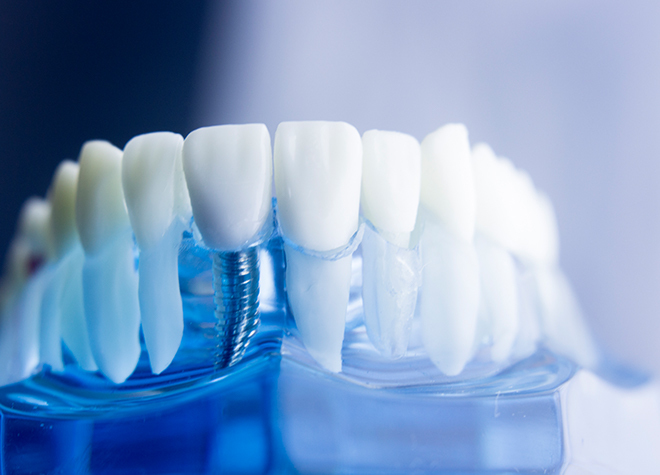 インプラントによって口内環境を整えることで、残された歯も守れる治療と考えます