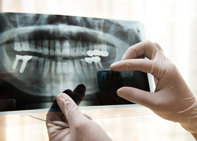 健康な歯への負担が少ない、予防としてのインプラント治療。