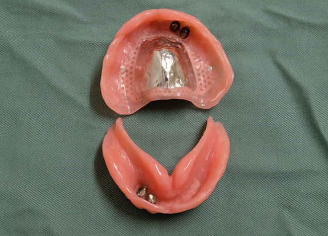 『テレスコープ義歯』患者さまお一人おひとりに合った入れ歯・義歯をご提供
