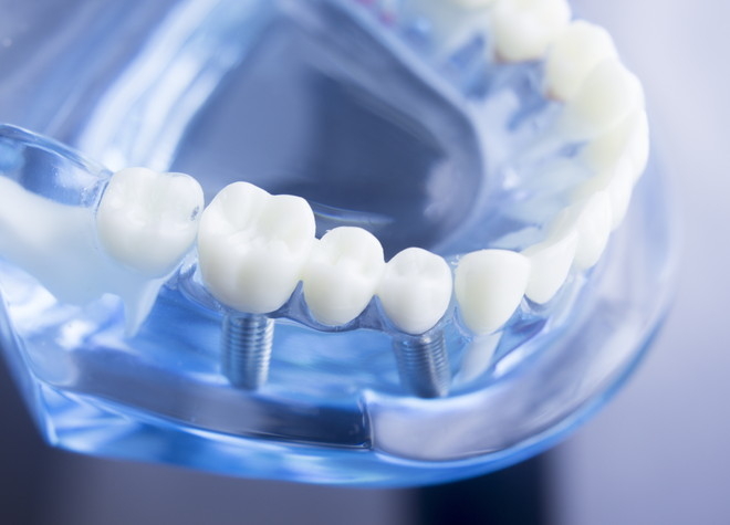 インプラントは天然歯と近い噛み心地で、他の歯に負担をかけず残っている歯を守ることができます
