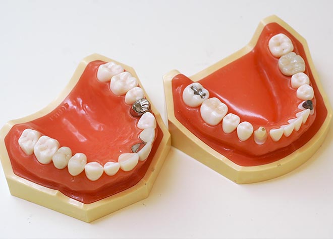 治療する歯だけではなく、お口全体のことを考えてつめ物・かぶせ物を作製します。