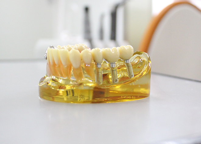 健康な歯を守り、天然歯のように噛めるインプラント治療に対応しています。