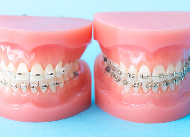 歯並びを整えることは、見た目の改善だけでなく虫歯や歯周病の予防にもつながります