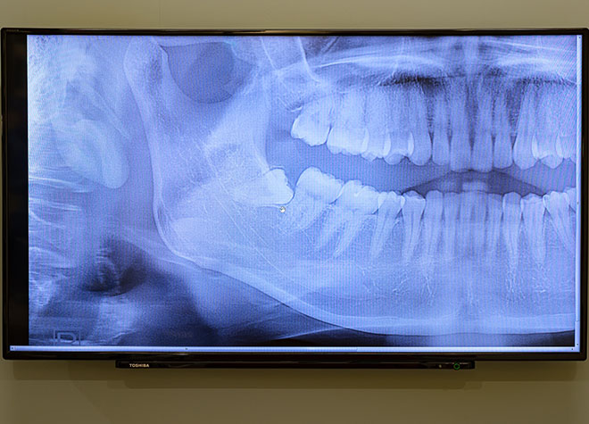親知らずはほかの歯へ悪影響を及ぼす可能性があるので、まずは歯科医院でチェックをしましょう