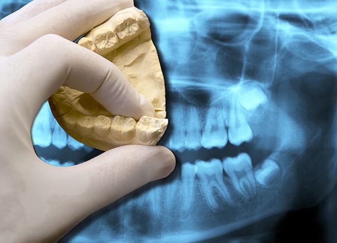 治療後の痛みや腫れも考慮しながら親知らずの抜歯を行います