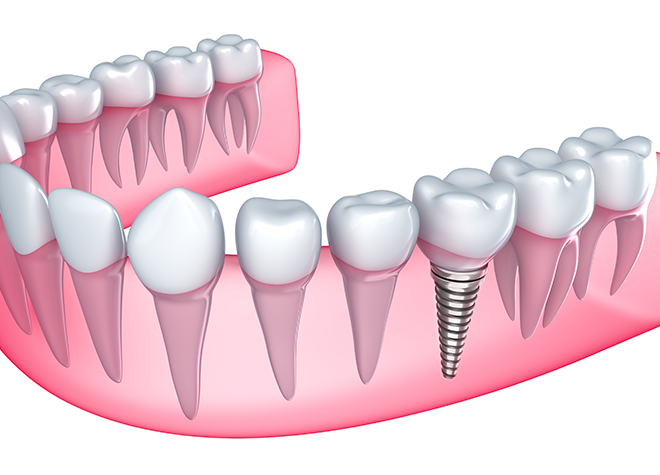 患者さまの天然歯を守るための、様々な選択肢を提案。