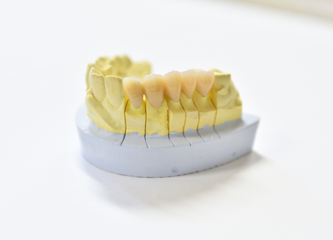 しっかりと噛めて、残った歯への負担も少ないインプラント