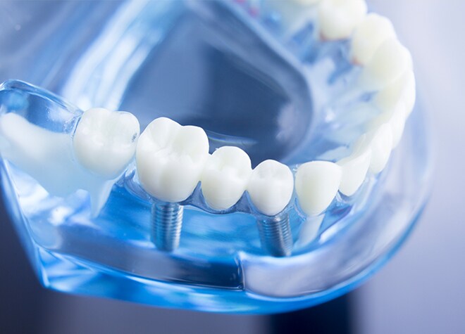 さまざまなお口の状態に合わせて、インプラント治療を行っています！