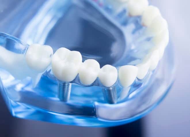 短い期間で手術が完了し、ご自身の歯のように食事や会話を楽しめます！