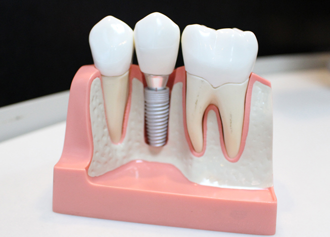 これ以上歯を失うことを防ぐために、インプラント治療をおすすめしています