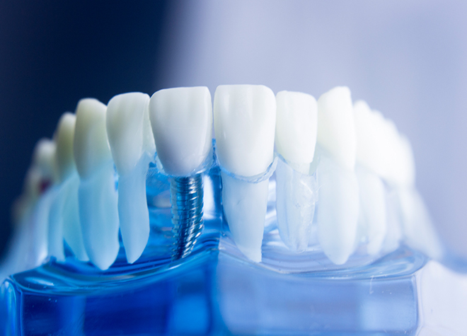 失った歯を補う方法の一つとして、インプラント治療をご提案しています