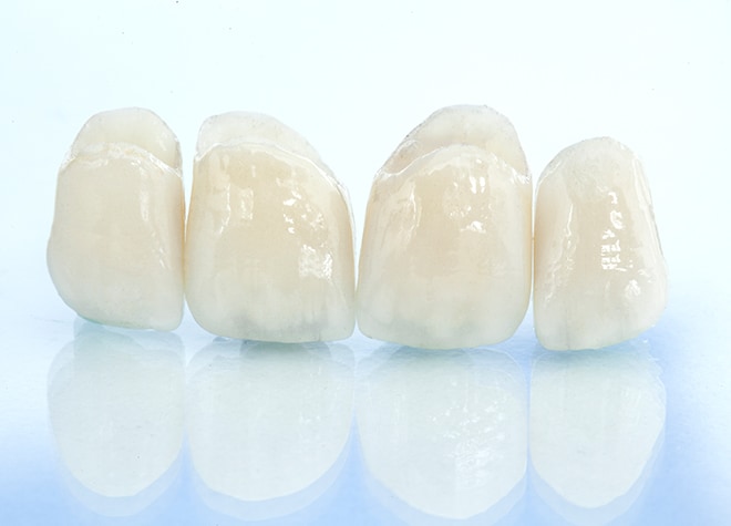 天然歯のように透明感のあるつめ物・かぶせ物もご用意しています。お気軽にご相談ください