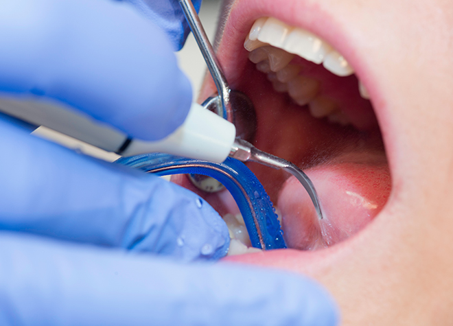 歯周組織再生療法に対応可能。重度の歯周病の方もぜひお越しください