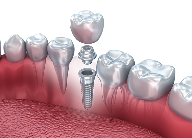 歯を失った場合の選択肢として、しっかり噛めることが特徴のインプラント治療を提供しています