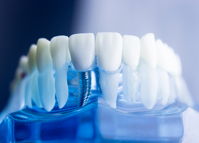 ご自身の歯のように噛めるインプラントは、「第二の永久歯」とも呼ばれています