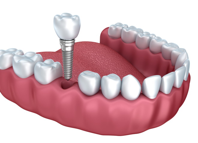 －インプラント－　健康な歯に負担をかけずに欠損部の機能を改善させる