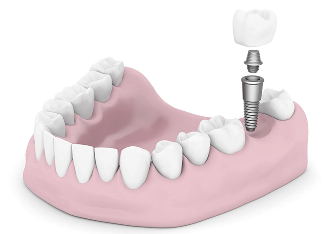 歯を失ってしまった方には、天然歯のような噛み心地を再現できるインプラント治療がおすすめです