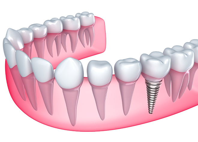 入れ歯に抵抗のある方、お使いの入れ歯が合わない方へ。「インプラント治療」を一度ご検討ください