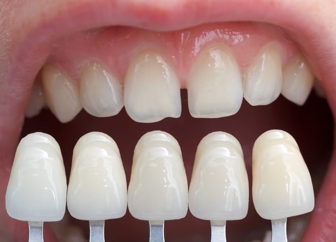 ホワイトニングにより、患者さま自身の歯を、天然歯の白さに近づけることができます