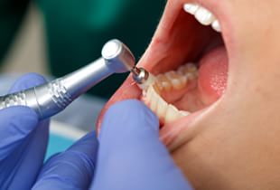 できる限り歯を残す治療<br />～「治療」から「予防」への注力